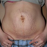 Umbilical Hernia Scar