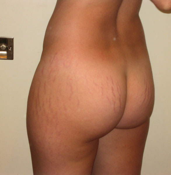 Huge Stretch Marks Porn - Nude woman with strech marks - XXX photo