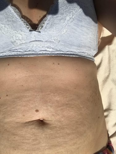 Postpartum umbilical hernia/tummy tuck - June 2020 Babies